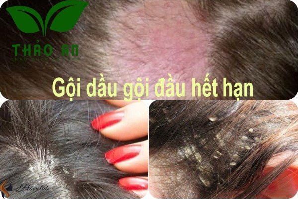 Dùng dầu gội đầu hết hạn - Có an toàn hay không?